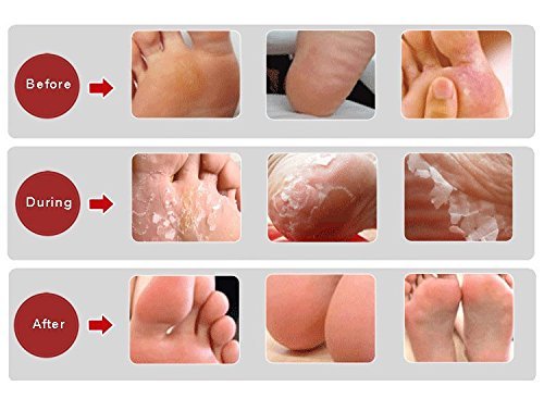 Baby Foot Peel Review